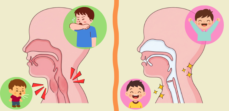 クループ症候群で喉頭から気管が腫れて気道が狭くなる仕組みを示したイラスト図解