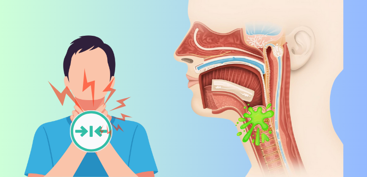 喘息によって炎症を起こし痰が溜まった気道の模式図イラスト