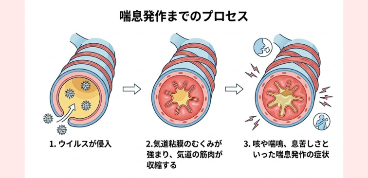 喘息発作までの３つのプロセスを示した図解