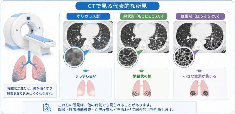 CTで見る代表的な所見