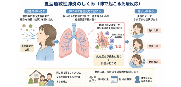 夏型過敏性肺炎が起こる仕組み